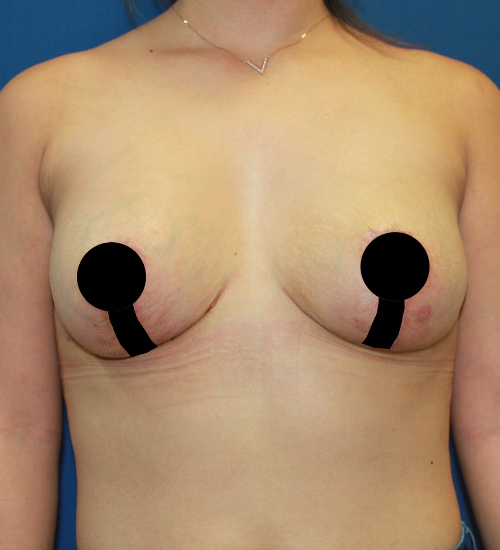 cirugia-de-busto