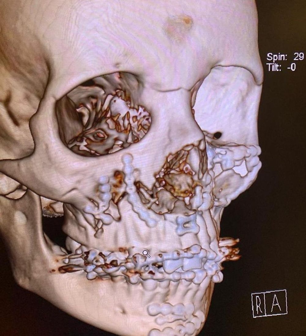 fracturas-faciales